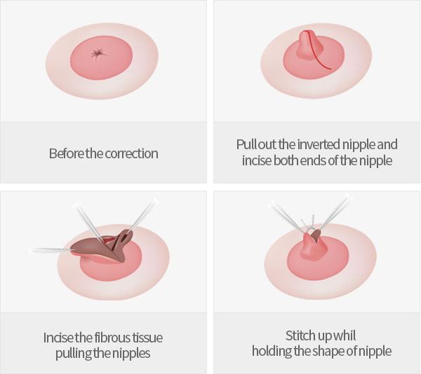 Nipple Surgery (Inverted, Protruding, Areola)