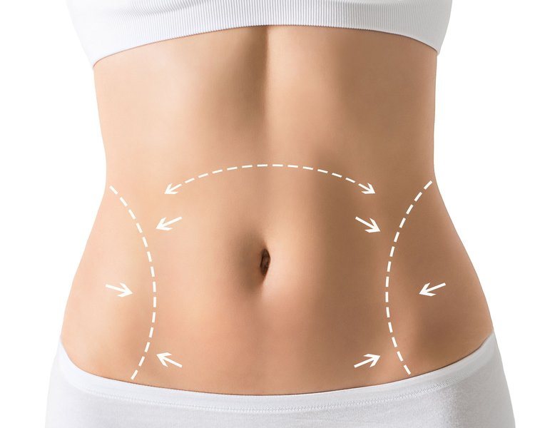 Tummy Tuck Dr Gideon Maresky(Abdominoplasty, Liposuction)